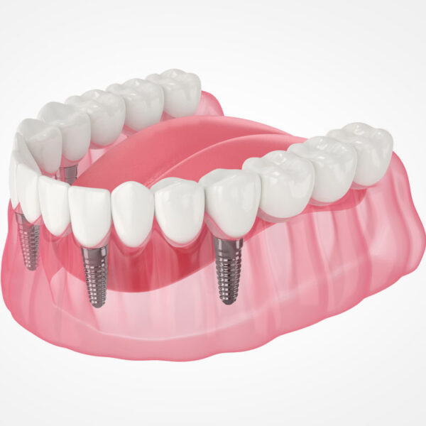 Does It Hurt To Get Dental Implants?