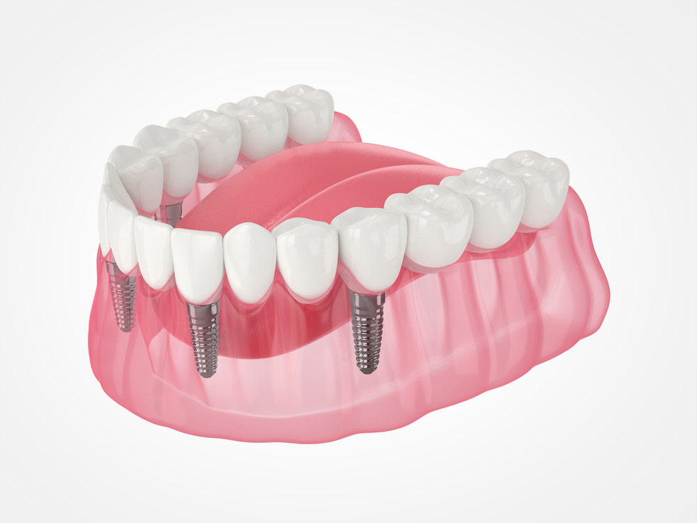 Does It Hurt To Get Dental Implants? Does It Hurt To Get Dental Implants?