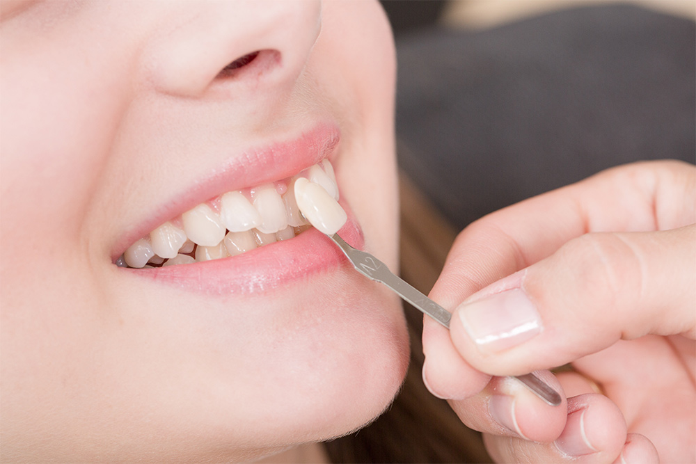 Porcelain dental veneers in Pullman, WA – Jonny Fisher DDS