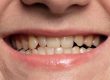 Will A Small Chipped Tooth Smooth Out