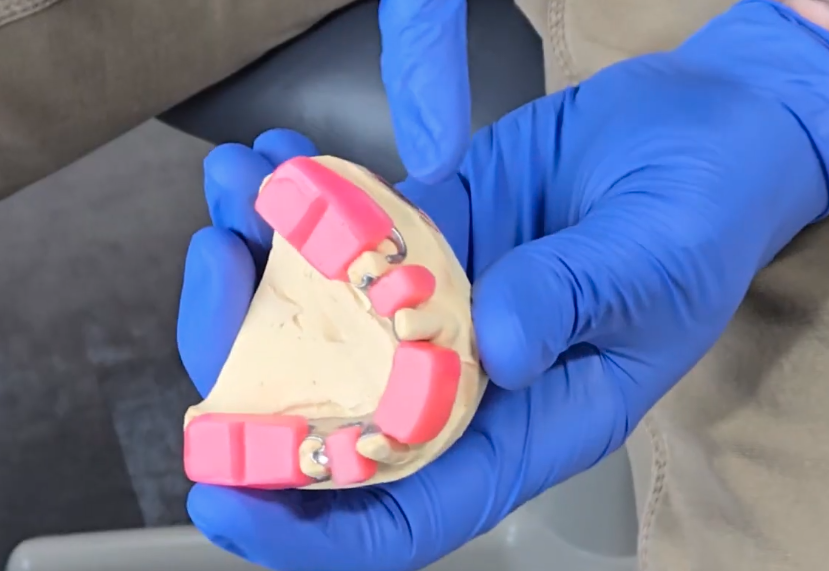 Dental implants at Jonny Fisher DDS Lewiston Idaho