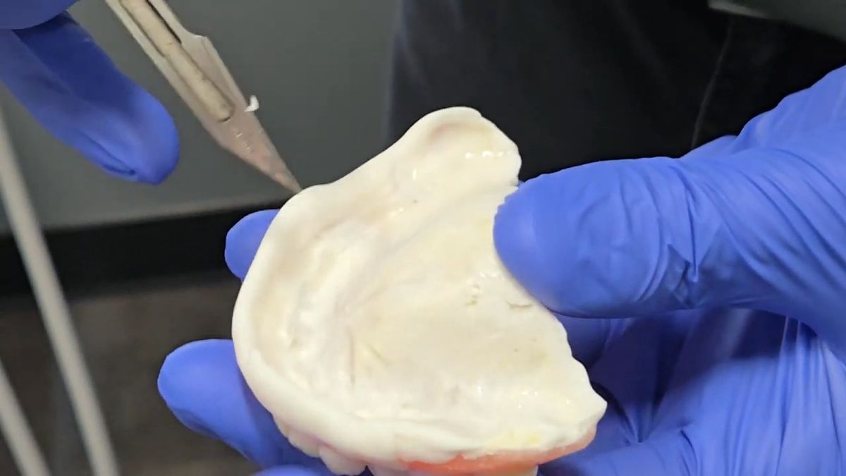 Trimming excess tissue conditioner from the inside of an immediate denture