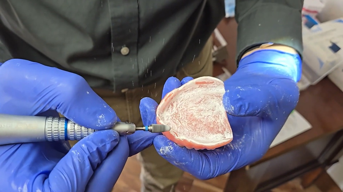 Adjusting an implant-supported denture with a dental handpiece