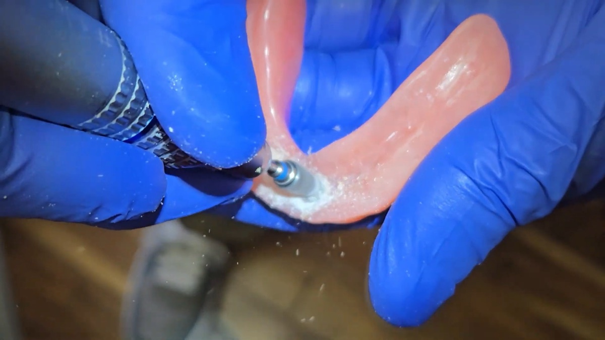Preparing the inside of an implant denture for a snap-in attachment at a Lewiston, ID dental office