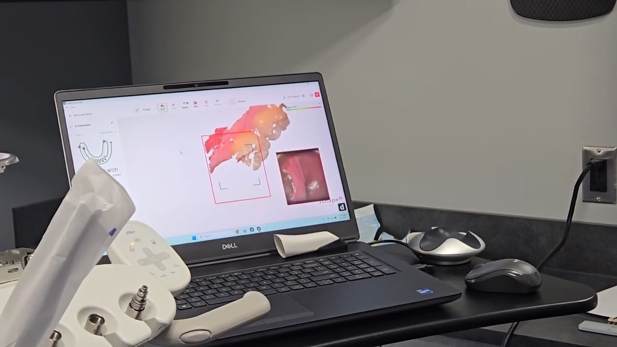 Digital 3D scan of a patient's teeth on a laptop during a dental implant appointment in Lewiston, ID