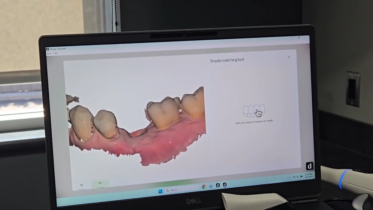 3D digital scan model of teeth and an implant site used to design a crown in Lewiston, ID